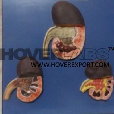 Catracted Kidney Model