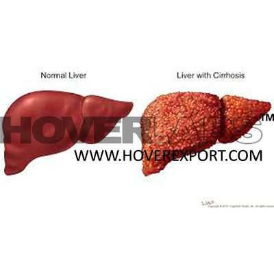 Cirrhosis Liver Model