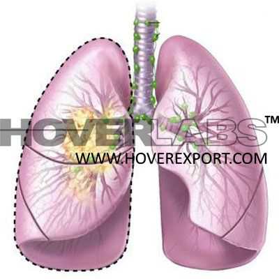 Lung Cancer Odel Model