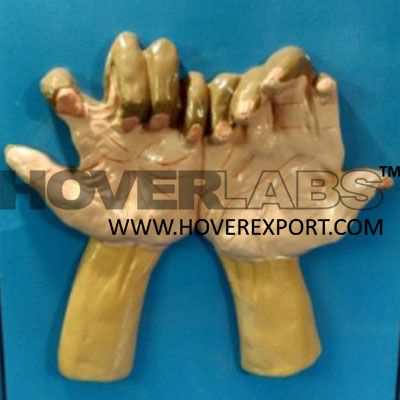 Claw Hands in Leprosy Model