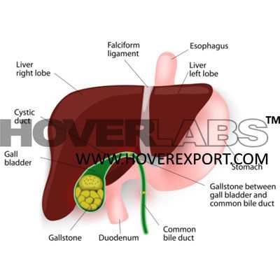 Cholalithiasis Gall Stone Model