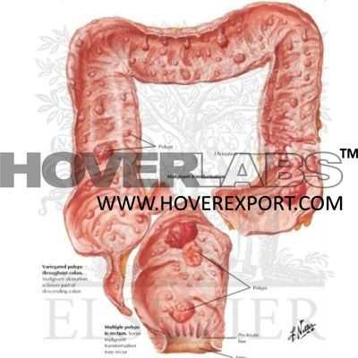 Familal Polyposis of Large Intestine Model