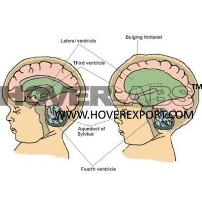 Hydrocephalus Model