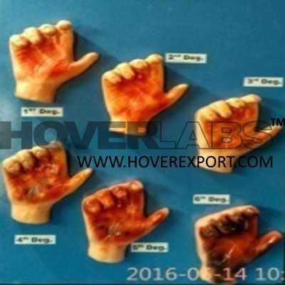 Degree of Burn Model