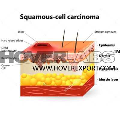 Squamous Cell  Carcinoma Model