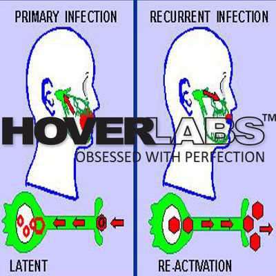 Primary & Recurrent Herpes Simplex Infection Model