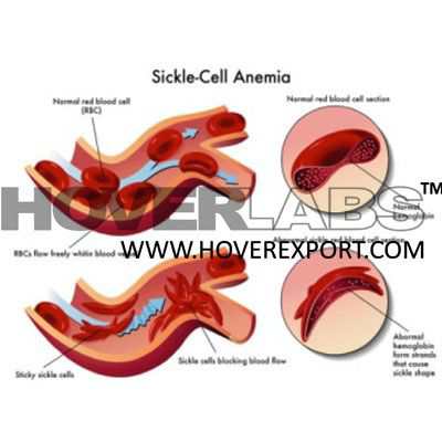Sickle Cell Anaemia Model