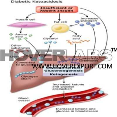 Diabetic Ketoacidosis Model