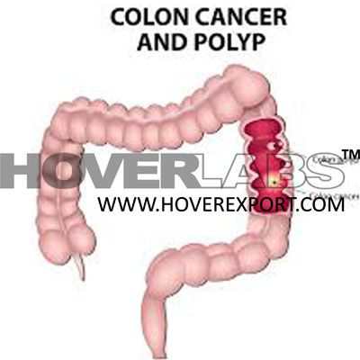 Colon Cancer and Polup Model